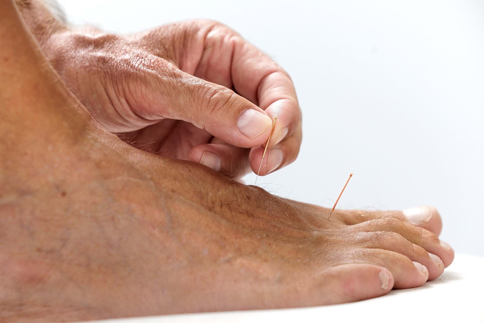 Akupunktur foden